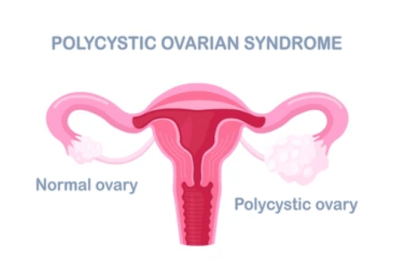 Best Homeopathy Doctor for PCOS in Pune: Dr. Tushar Mishra