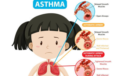 Homeopathy for Childhood Asthma